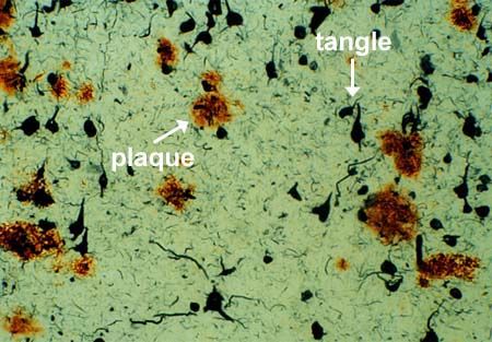 Amyloid plaques and tau proteins